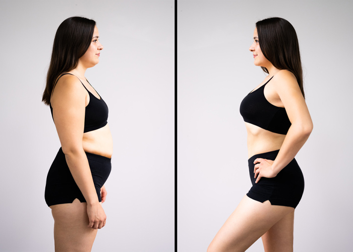 ابدومینوپلاستی