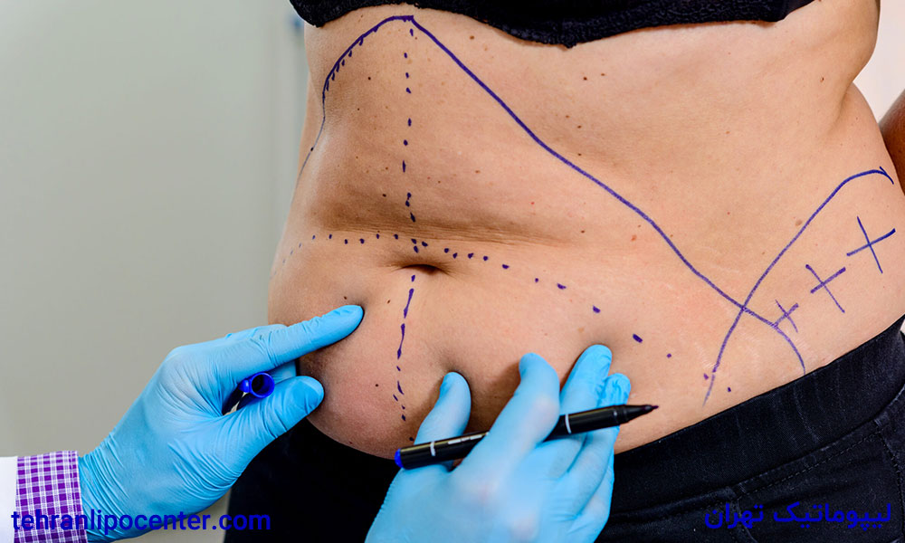 لیپوماتیک و پیکرتراشی ۳۶۰ درجه در ونک