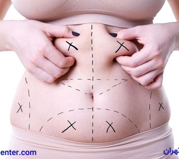 لیپوماتیک و پیکرتراشی ۳۶۰ درجه در ونک