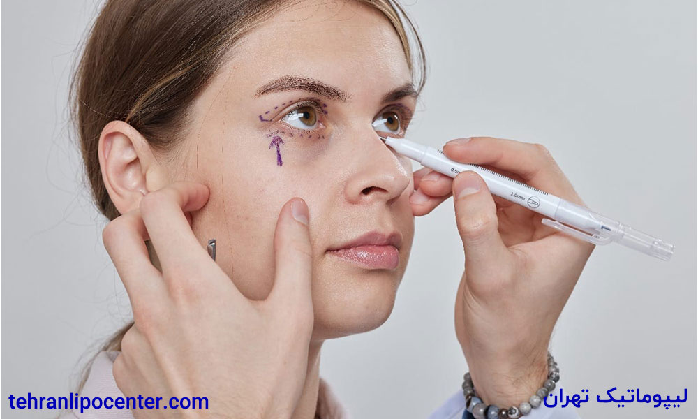 بلفاروپلاستی یا عمل افتادگی پلک در ونک