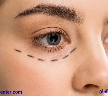 بلفاروپلاستی یا عمل افتادگی پلک در ونک