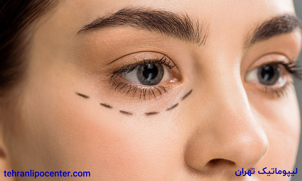بلفاروپلاستی یا عمل افتادگی پلک در ونک