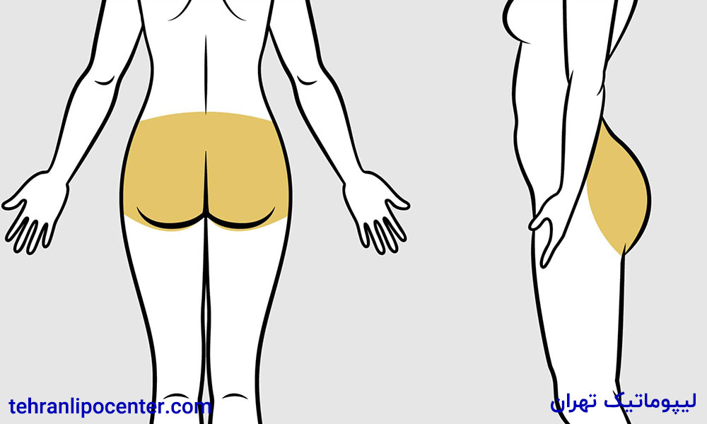 تزریق چربی به باسن در ونک