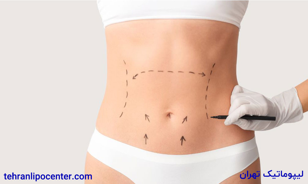 بهترین دکتر جراح ابدومینوپلاستی در ونک
